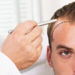 Hair Transplant dan Gaya Hidup Modern, Solusi Praktis untuk Penampilan Maksimal
