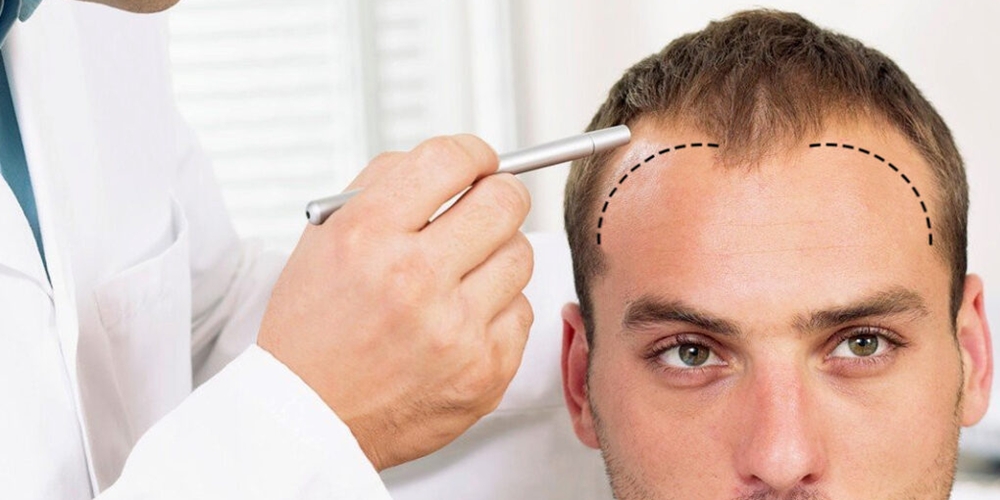 Hair Transplant dan Gaya Hidup Modern, Solusi Praktis untuk Penampilan Maksimal
